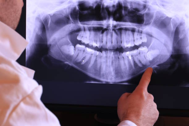 Best Emergency Wisdom Tooth Extraction in Tchula, MS